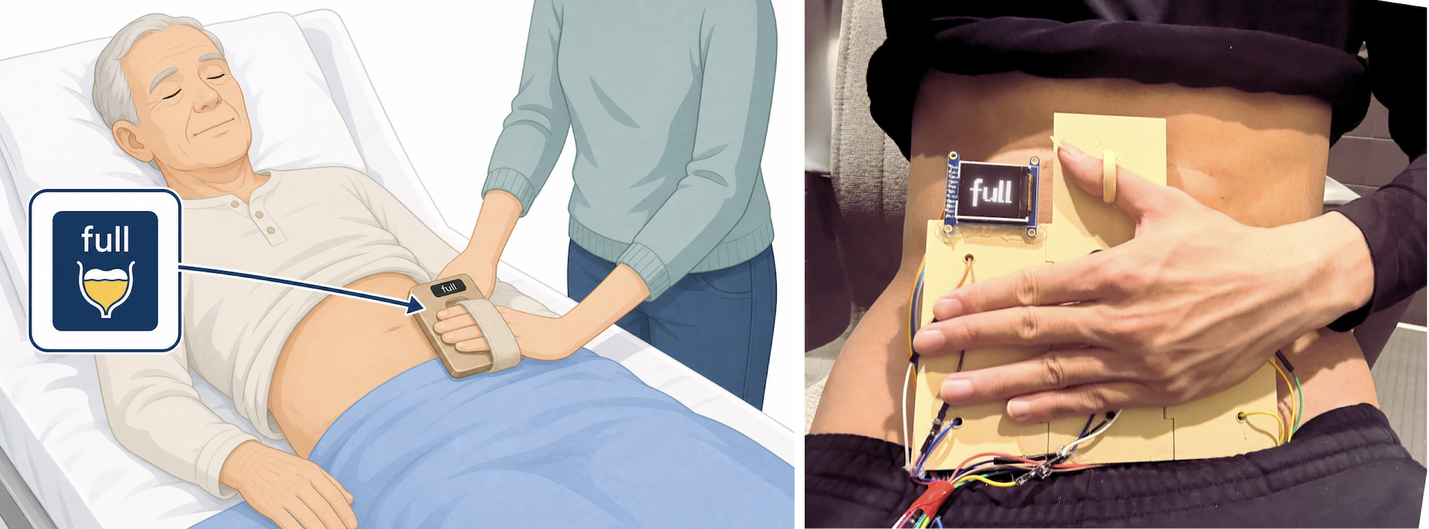 WeeCare: handheld bladder fullness sensing with a conformable pad